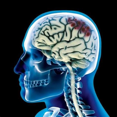O Que Significa Tce Na Enfermagem - Traumatismo Crânio Encefálico (TCE) | Enfermagem - Mais completo da ...