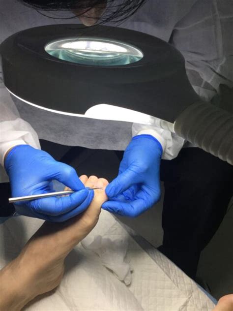 Ingrown Toenails: A Complete Guide - Flagstaff Foot Doctors