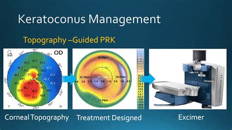 Keratoconus Management Corneal Crosslinking And Topography Guided Prk At