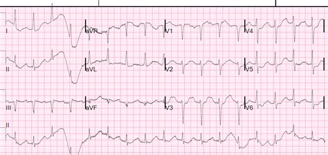 Dr Smiths Ecg Blog Patient With Severe Dka Look At The Ecg