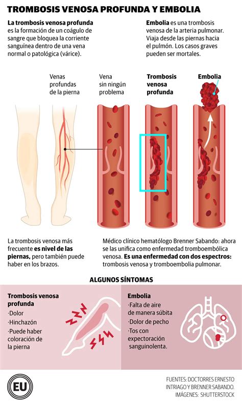 Qu Es La Trombosis Venosa Profunda La Enfermedad Que Padece La