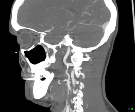 Vertebral Artery Fenestration V3 Segment Image