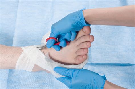 Electric Stimulation Found to Accelerate Chronic Wound Healing