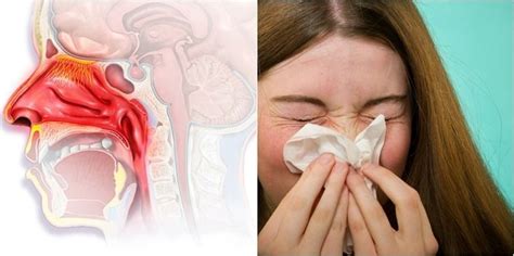 Blocked Nose All the Time: What is Nasal Congestion? | SurgMedia