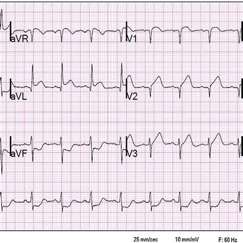 Ekg With St Elevation