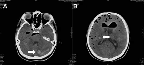 Figure From Diffuse Pneumocephalus Associated With Infratentorial And