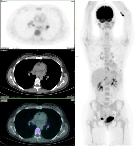 Mip And Axial Pet Ct And Fused Pet Ct Images Of Progress Pet Ct