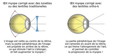 Les Lentilles De Contact Amavue Opticiens