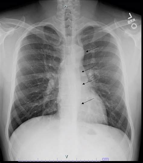 Aortic Aneurysm On Chest X Ray Hot Sex Picture