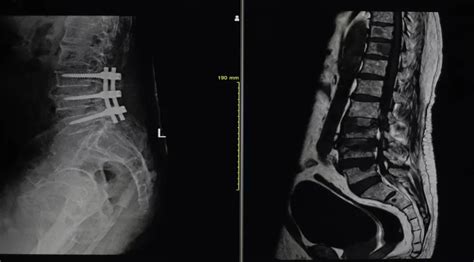 Faster Spinal Fusion Recovery What Steps To Make