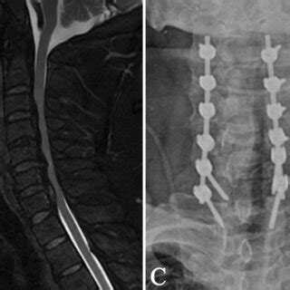 Instrumented Fusion Versus Instrumented Non Fusion Following Expansive