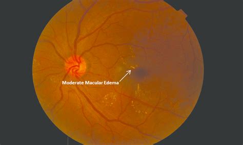 Mild Nonproliferative Diabetic Retinopathy