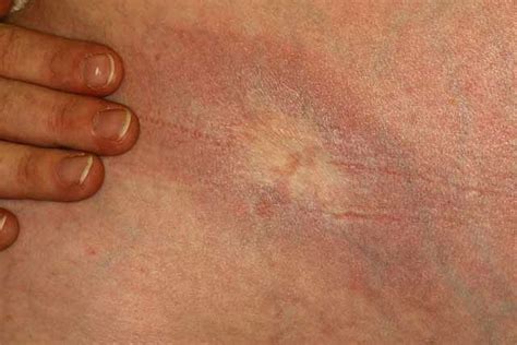 Morphea Scleroderma Treatment Causes And More