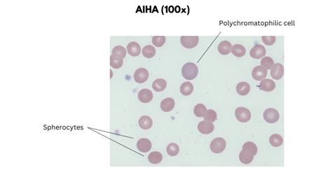 Hemolytic Anemias The Blood Project