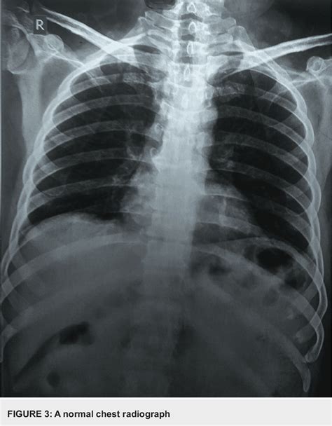 Figure From Extrapulmonary Tuberculosis Presenting As Stage V