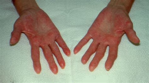 Hand Dermatitis is Common and Can Cause Redness and Irritation