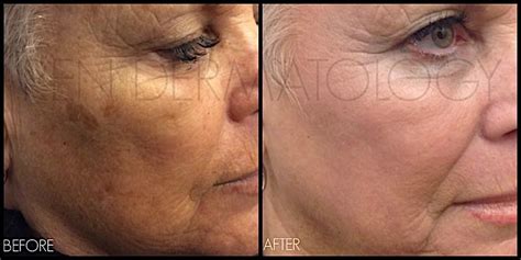 Laser Treatment Gallery REN Dermatology Aesthetics