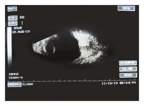 Ocular B Scan Ultrasound Of The Right A And Left B Eyes The