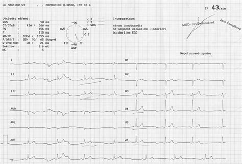 EKG z praxe 7 Medicína nemoci studium na 1 LF UK