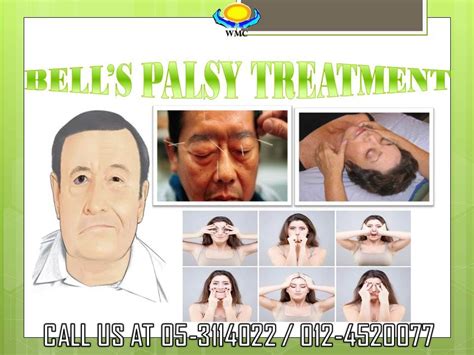 Bell's Palsy Exercises Handout