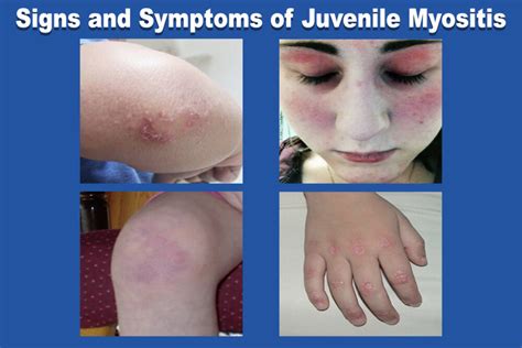 Myositis Janise Nicholson