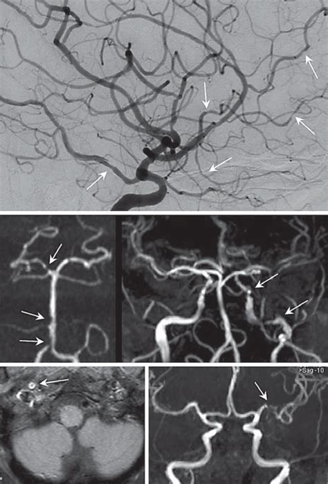 A Patient 1 Digital Subtraction Angiography Showing Multifocal