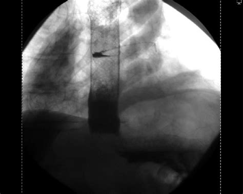 A Follow Up Gastrografin Swallowing Study Showing An Esophageal Stent