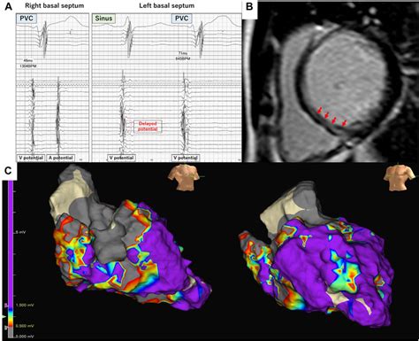 A The Intracardiac Electrograms Recorded By An Hd Grid Mapping