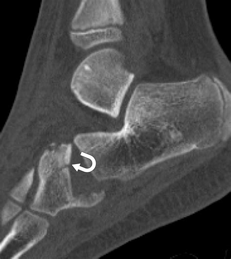 Normal Anatomy And Traumatic Injury Of The Midtarsal Chopart Joint