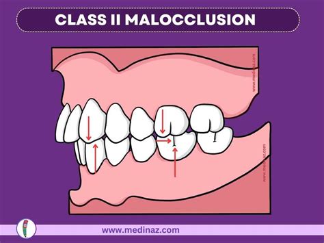 Angles Classification Malocclusion Dental Notes