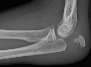 Olecranon Fracture - Physiopedia