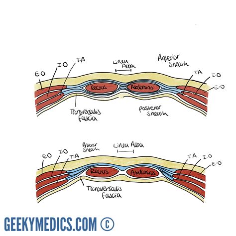 Abdominal Surgical Incisions Gridiron Pfannenstiel Geeky Medics