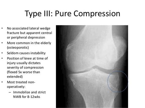 Knee Fractures