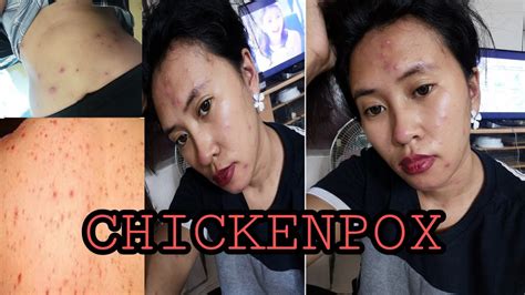 Chickenpoxbulutong Tubig Treatment Symptoms Medicine Youtube