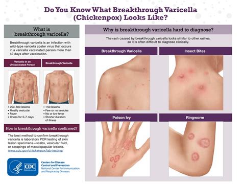 Breakthrough Varicella Fact Sheet Chickenpox Varicella CDC