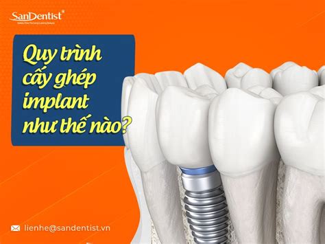 Các bước để thực hiện quy trình cấy ghép implant