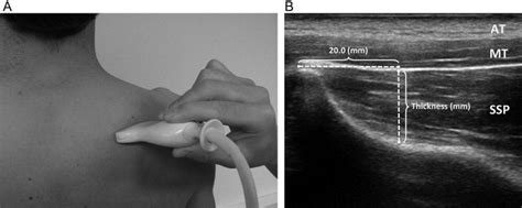 Rehabilitative Ultrasound Imaging Of The Supraspinatus Muscle Intra And Interrater Reliability