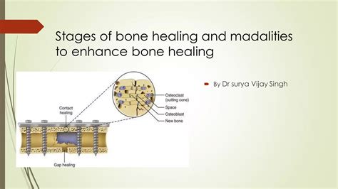 Stages of Bone healing and madalities to enhance bone healing | PPT