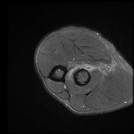 Distal biceps brachii tendon rupture | Radiology Case | Radiopaedia.org