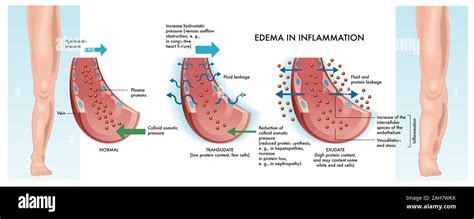 Main stages of edema inflammation illustrated in medical diagram Stock ...