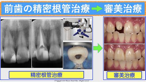 前歯の精密根管治療とオールセラミッククラウンによる審美治療 船橋駅3分の歯医者｜川手歯科医院