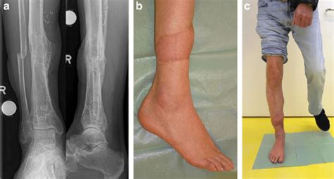 One and a half years after removal of the Ender nail the tibia was ...