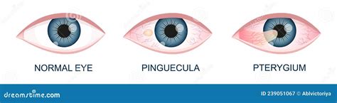 Eye Healthy With Pinguecula And Pterygium Growing Onto Cornea