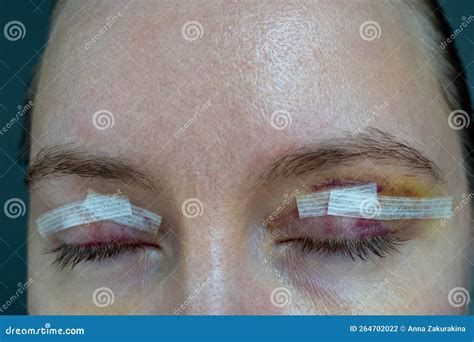 Close Up Woman Eyes After Plastic Surgery Yellow Red Skin Bruising Blepharoplasty Operation