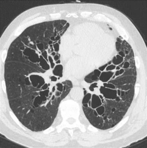 Ct Scan Of The Chest Without Contrast Shows Central Cystic Bronchiectasis Download