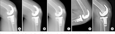 Figure 2 From Comparison Of Revision Rates Due To Aseptic Loosening Between High Flex And