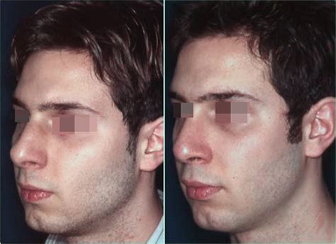 Naso Deviato Younique Rhinoplasty Pietro Palma Md