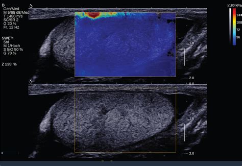 Differences Of Standard Values Of Supersonic Shear Imaging And Arfi