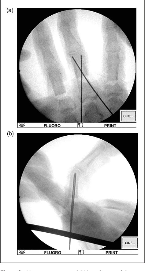 Figure From Percutaneous Fixation Of Unstable Proximal Phalanx