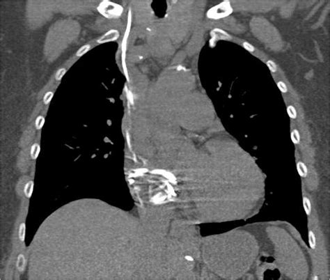 Intracardiac Migration And Knotting Of A Ventriculoperitoneal Shunt